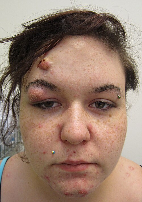 אקנה ציסטית קשה