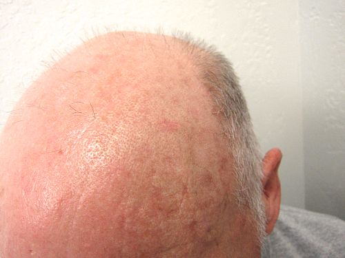 Actinic keratosis