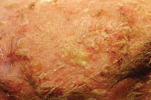 Actinic keratosis field cancerization
