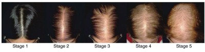 Female pattern hair loss stages