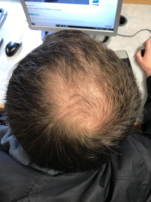 Male pattern hair loss