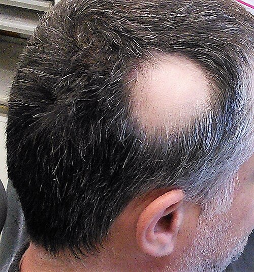 Alopecia areata patch