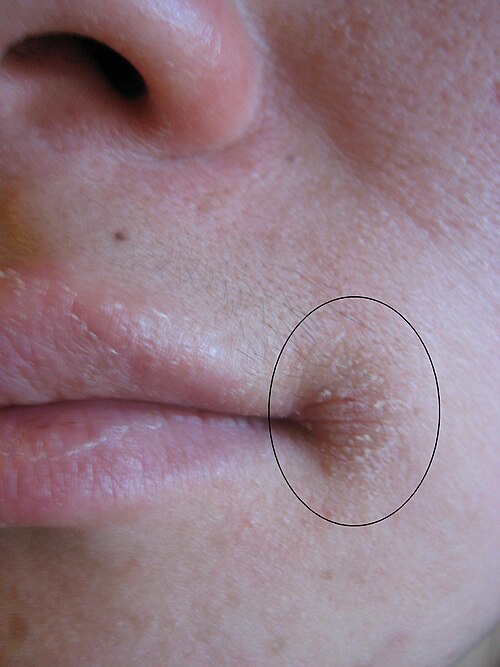 כייליטיס אנגולרית