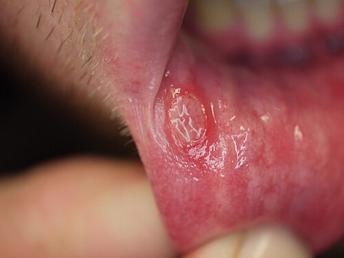 Aphthous stomatitis