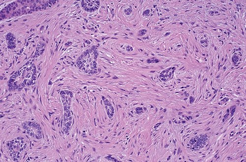 Basal cell carcinoma