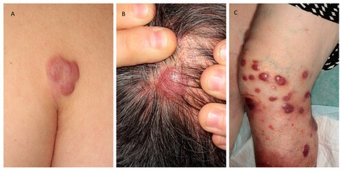 Cutaneous B-cell lymphoma