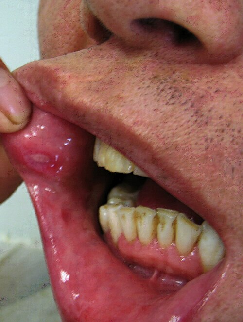 Behcet disease oral ulcer