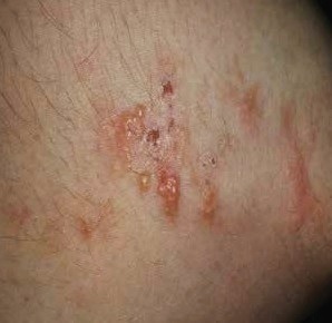 Dermatitis herpetiformis