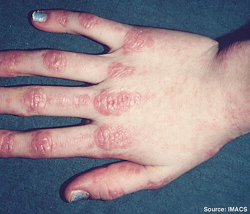 Dermatomyositis Gottron papules