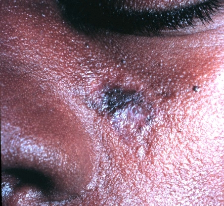 Discoid lupus erythematosus