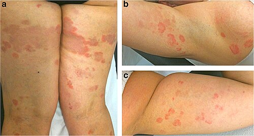 Erythema annulare centrifugum