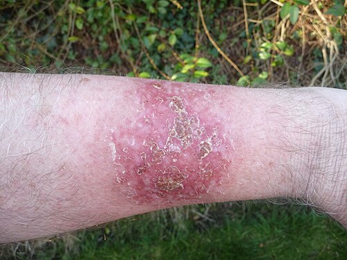 Efudix 5-FU post treatment