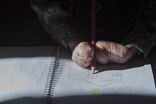 Epidermolysis bullosa