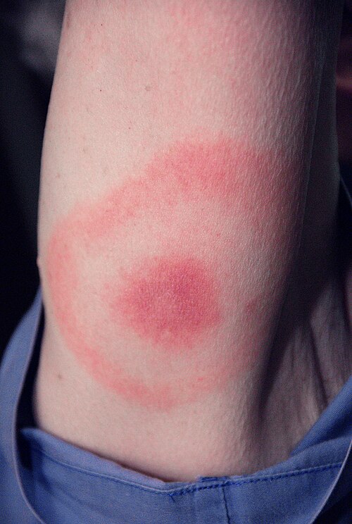 Erythema Migrans