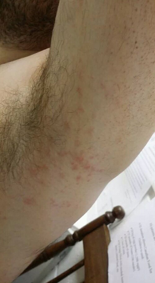 Erythema multiforme target lesions