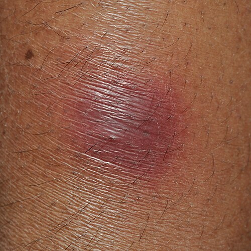 Erythema nodosum