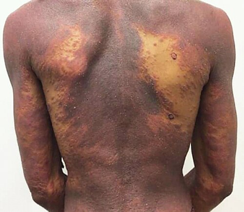 Erythroderma exfoliative dermatitis