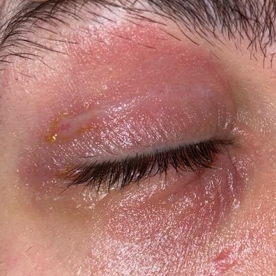 דרמטיטיס של העפעפיים