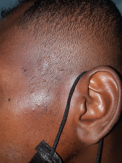 Genital lichen planus