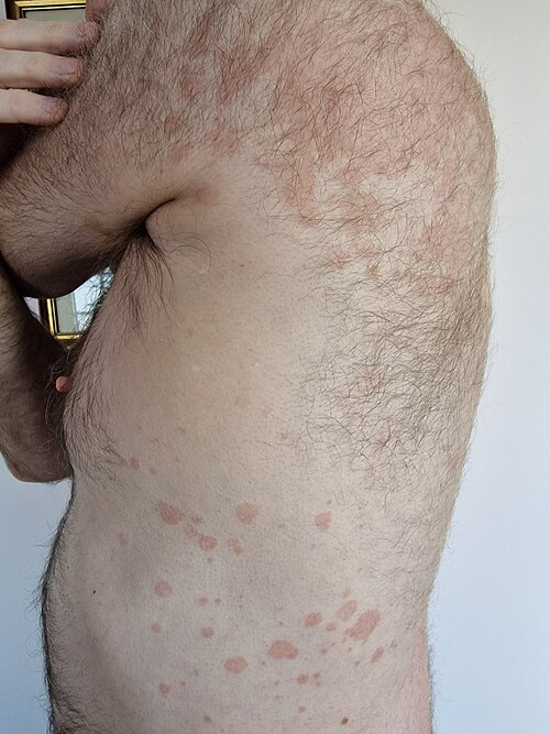 Guttate psoriasis