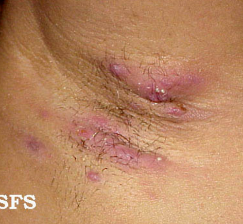 Hidradenitis suppurativa Hurley I