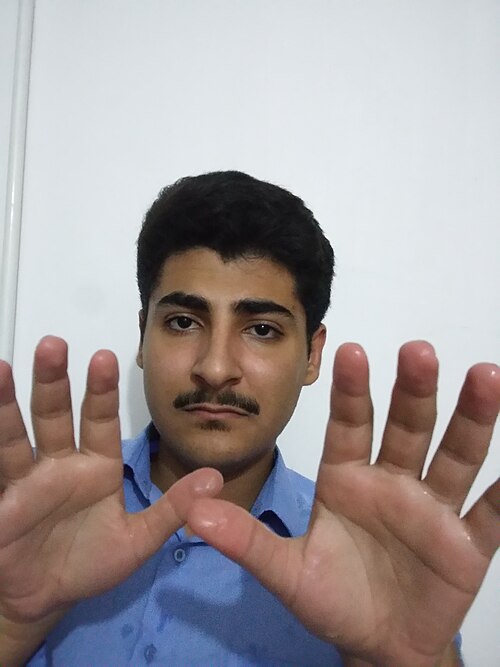 Hyperhidrosis excessive sweating