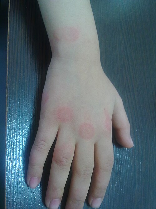 עקיצות חרקים