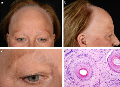Frontal fibrosing alopecia (LPP variant)