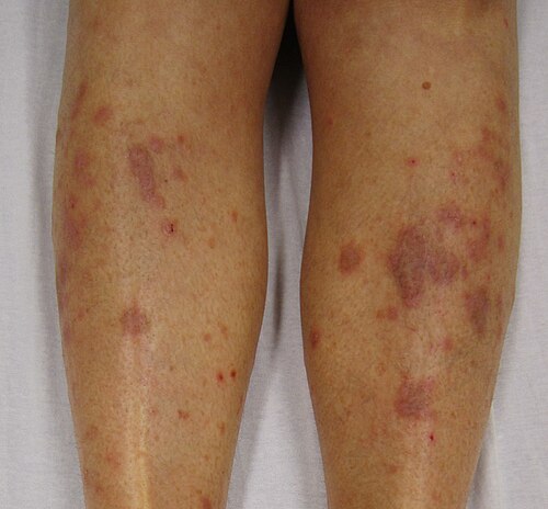 Lichen planus on legs