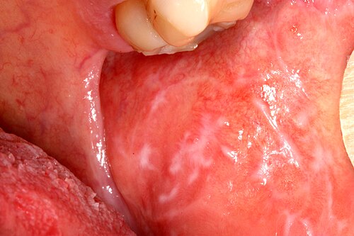 Oral lichen planus