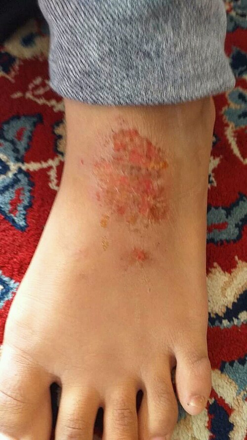 ליכן סימפלקס כרוניקוס