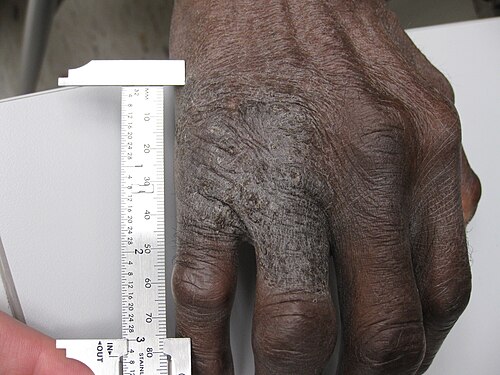 Lichen simplex chronicus