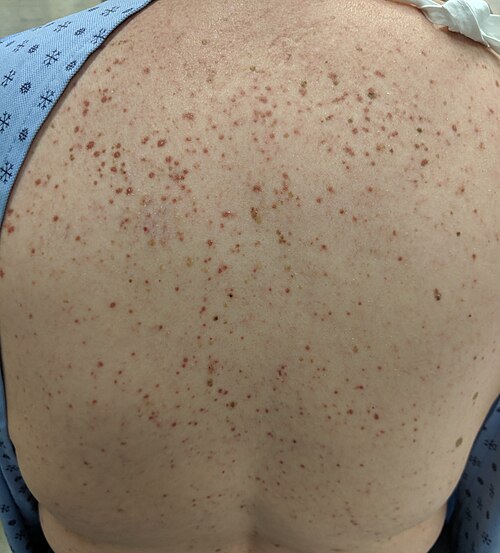 Cutaneous mastocytosis