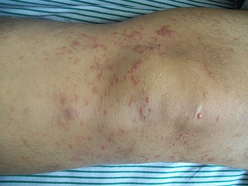 Mycosis fungoides early
