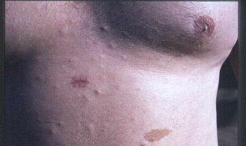 Neurofibromatosis type 1