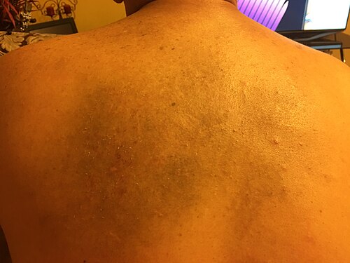 Notalgia paresthetica