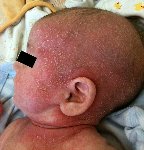 Pediatric atopic dermatitis