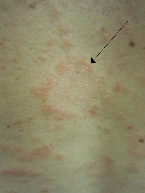 Pityriasis rosea herald patch