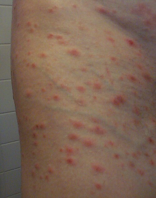 Pityriasis lichenoides PLEVA