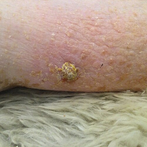 Porokeratosis on leg