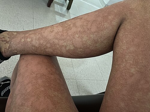 Pityriasis rubra pilaris