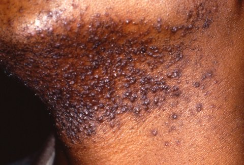 Pseudofolliculitis Barbae