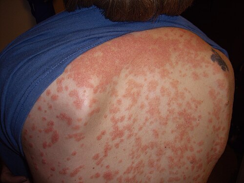 Guttate psoriasis widespread