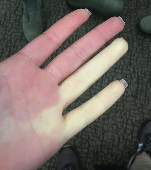 Raynaud phenomenon