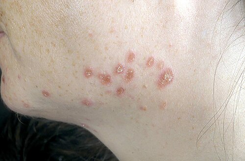 Cutaneous sarcoidosis