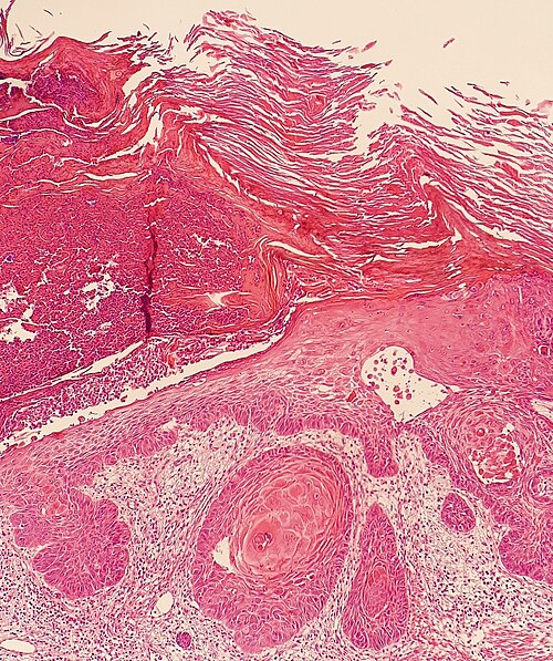 Squamous cell carcinoma