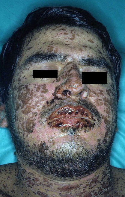 Stevens-Johnson syndrome
