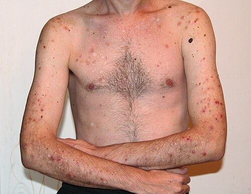 Neurotic excoriations