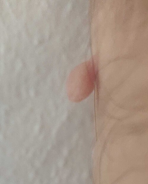 Skin tag acrochordon