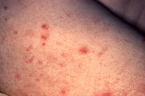 Secondary syphilis rash